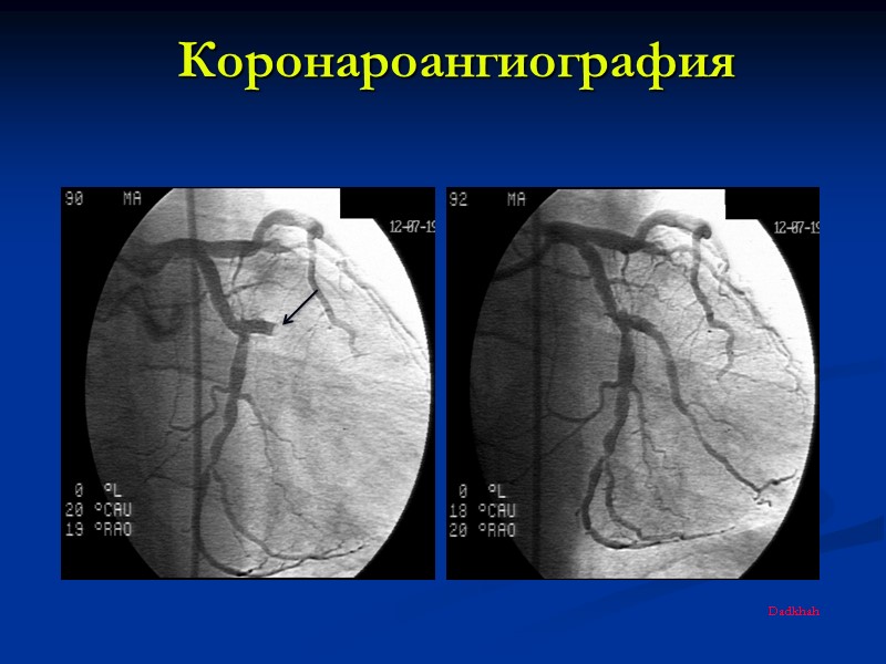Коронароангиография Dadkhah